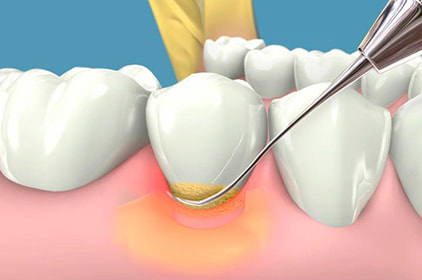 periodoncia con fonasa e isapres