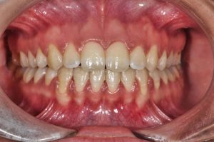 fotografía de una recesión gingival. Caso en Proyecto Encías