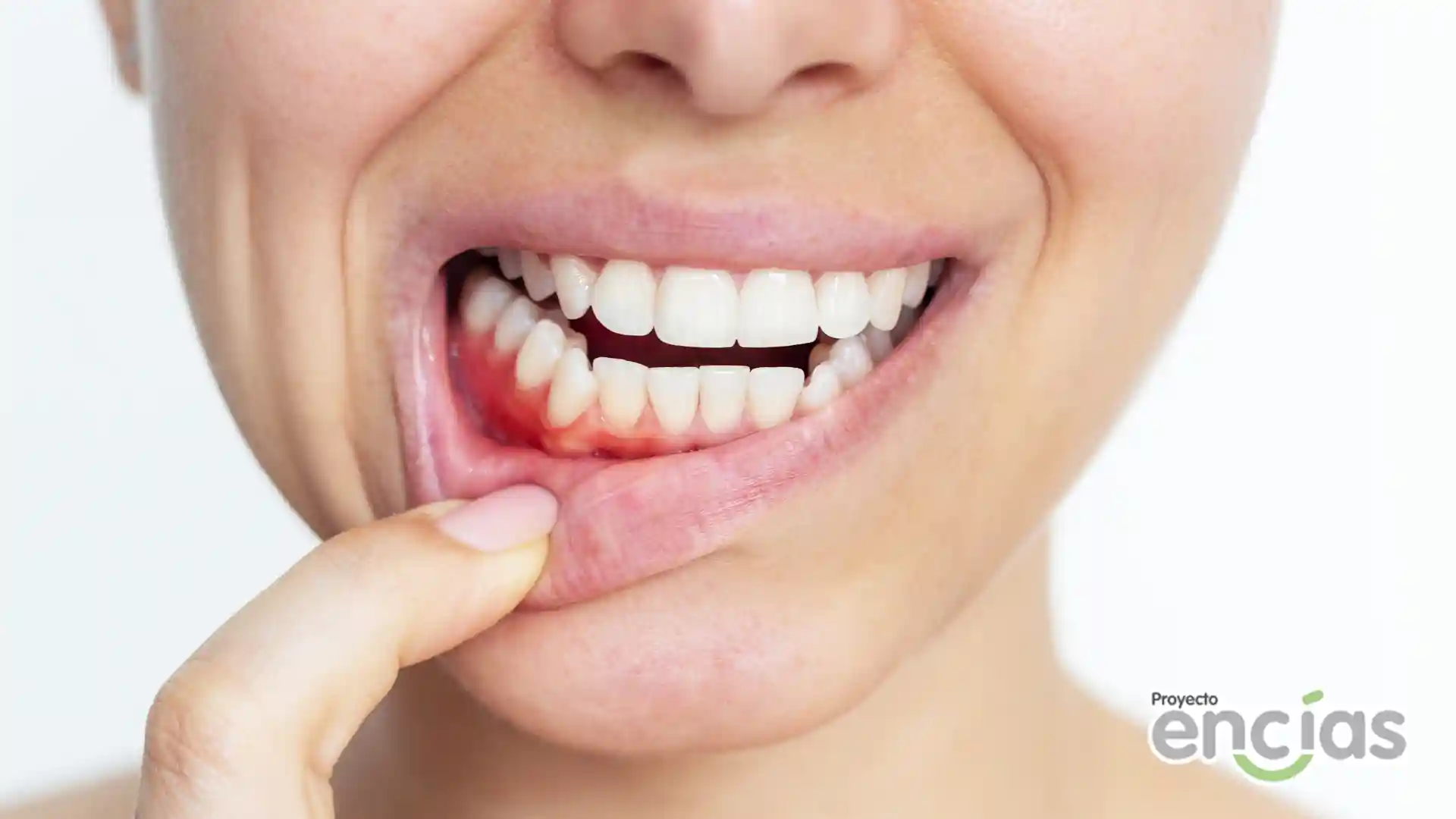 articulo de recesión gingival
